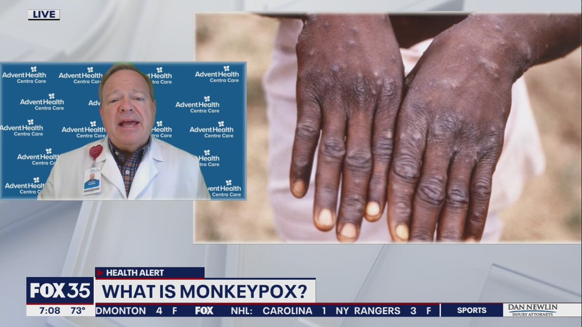 What is monkeypox? Central Florida doctor explains